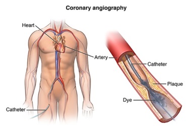 best hospital for angioplasty in purnia, cost of heart stenting in purnia